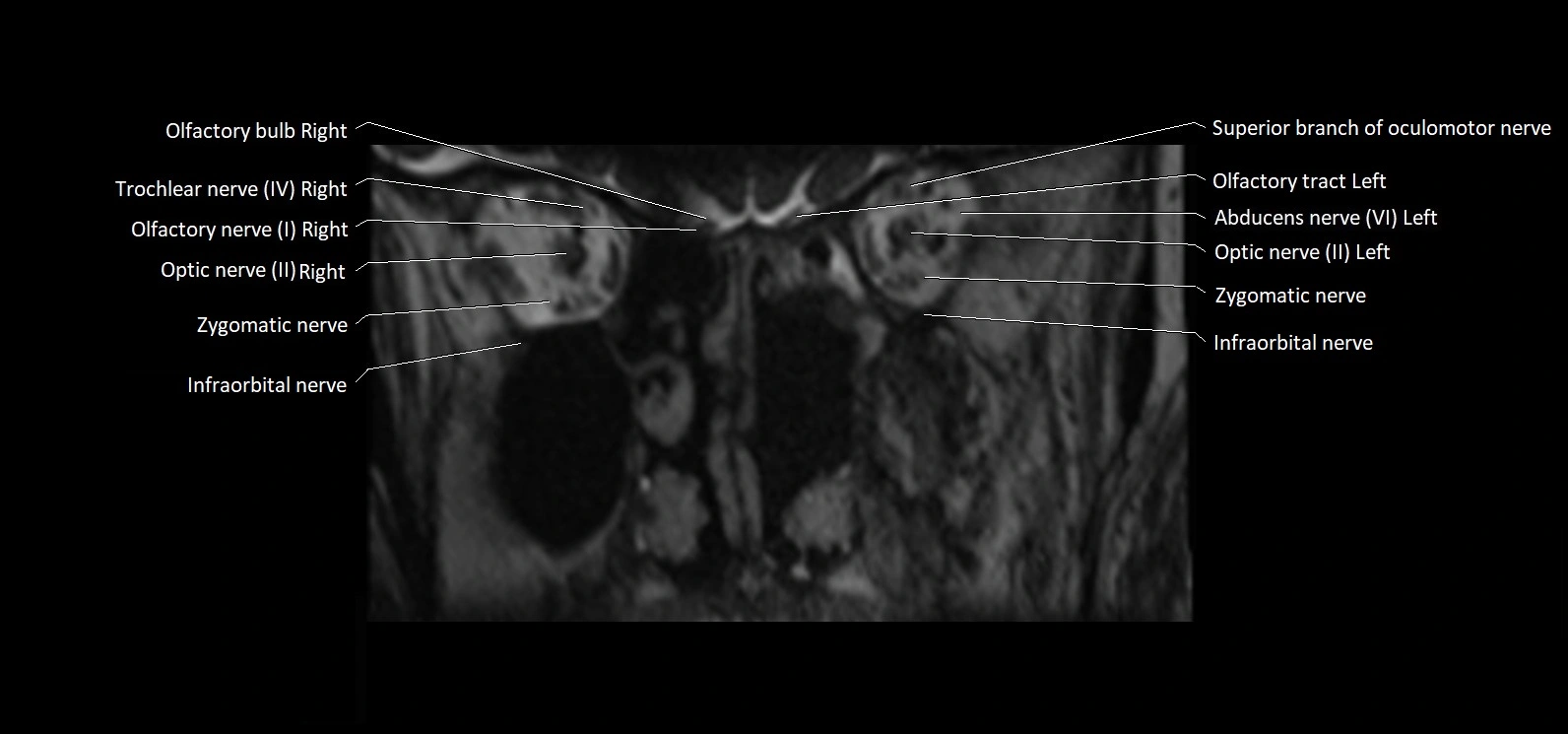 Cranial nerve cross sectional anatomy coronal 3T MRI image 9.webp